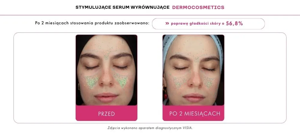Adapinoid efekty na skórze trądzikowej