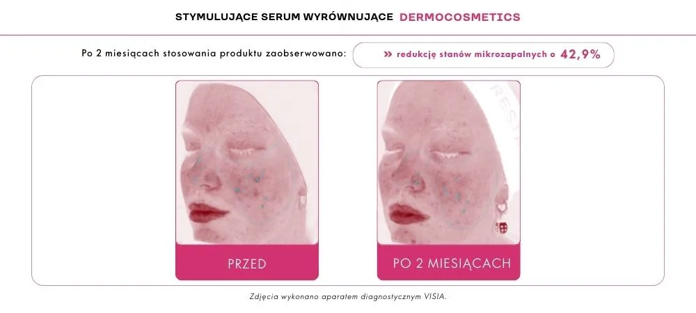 adapinoid efekty na trądzik