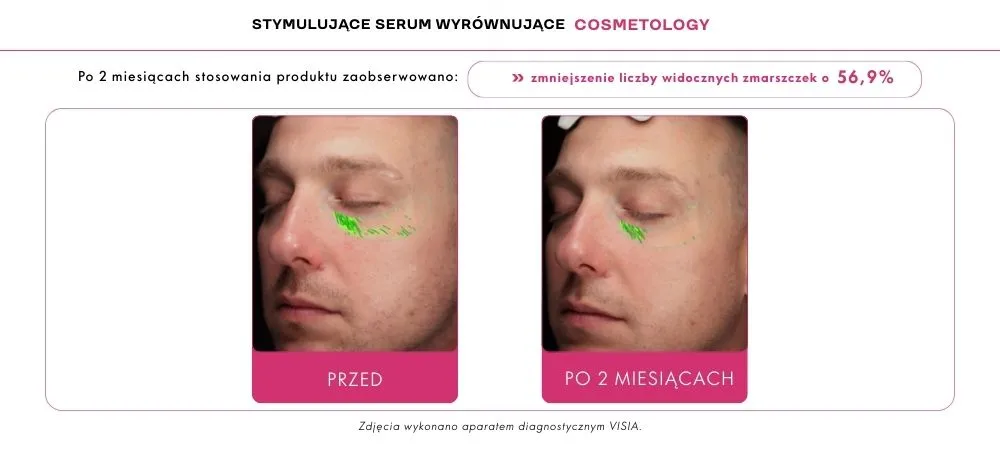 Adapinoid efekty zmarszczki