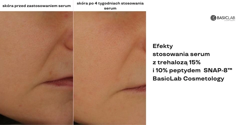 peptydy na bruzdy nosowo-wargowe efekty