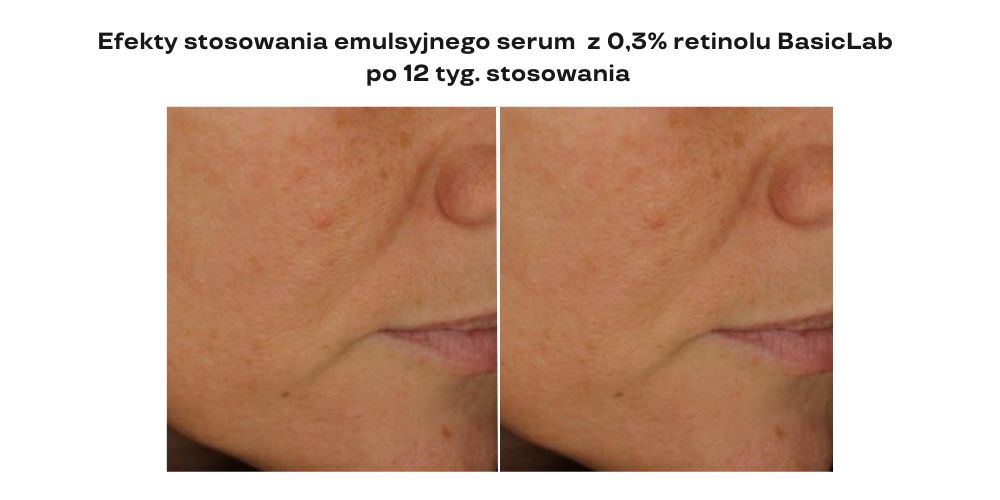 Badania retinol efekty stosowania