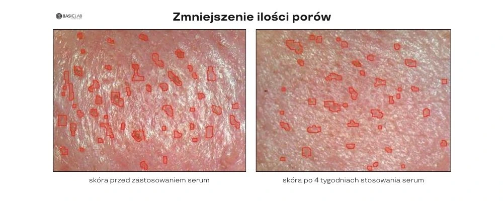 efekty pielęgnacji skóry trądzikowej