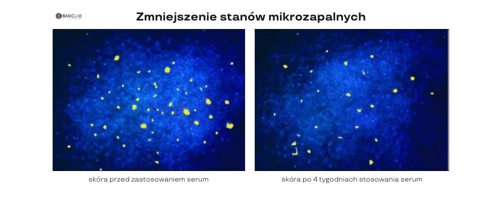 efekty pielęgnacji skóry trądzikowej serum na zaskórniki