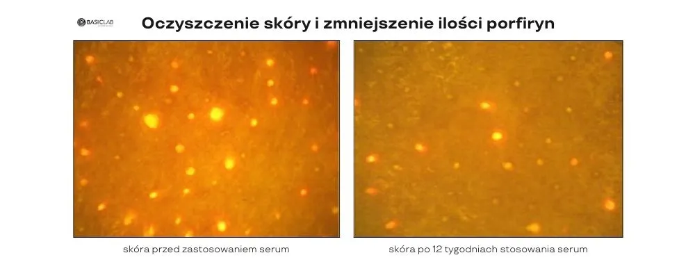 serum z niacynamidem efekty stosowania