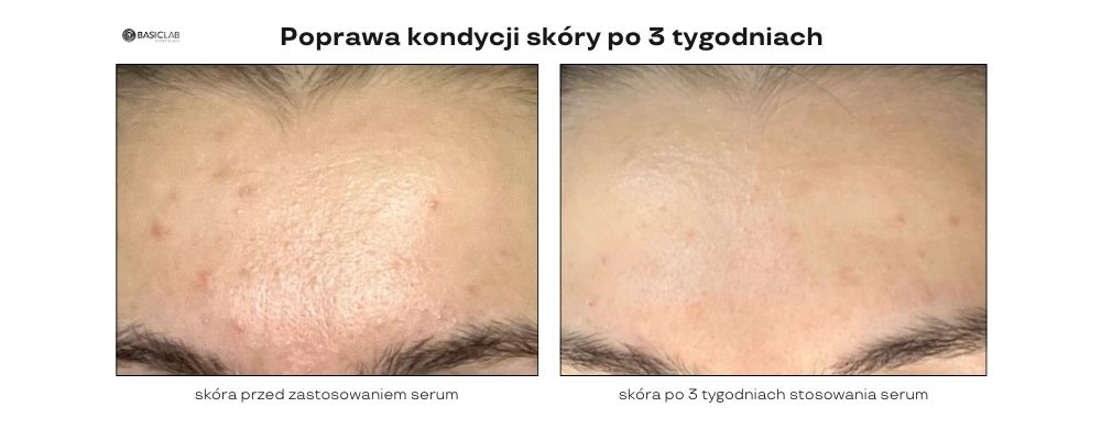 poprawa kondycji skóry trądzikowej po 3 tygodniach 