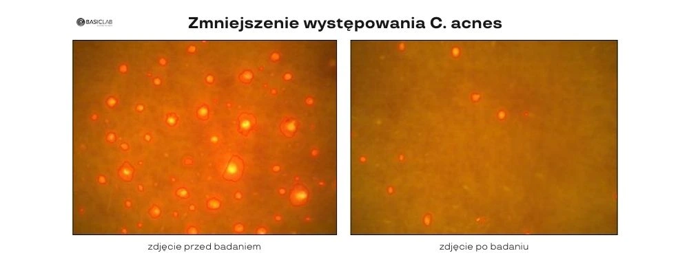 efekty serum punktowe