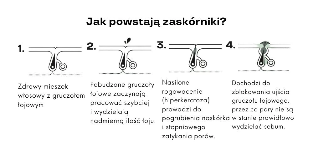 jak powstają zaskórniki zamknięte